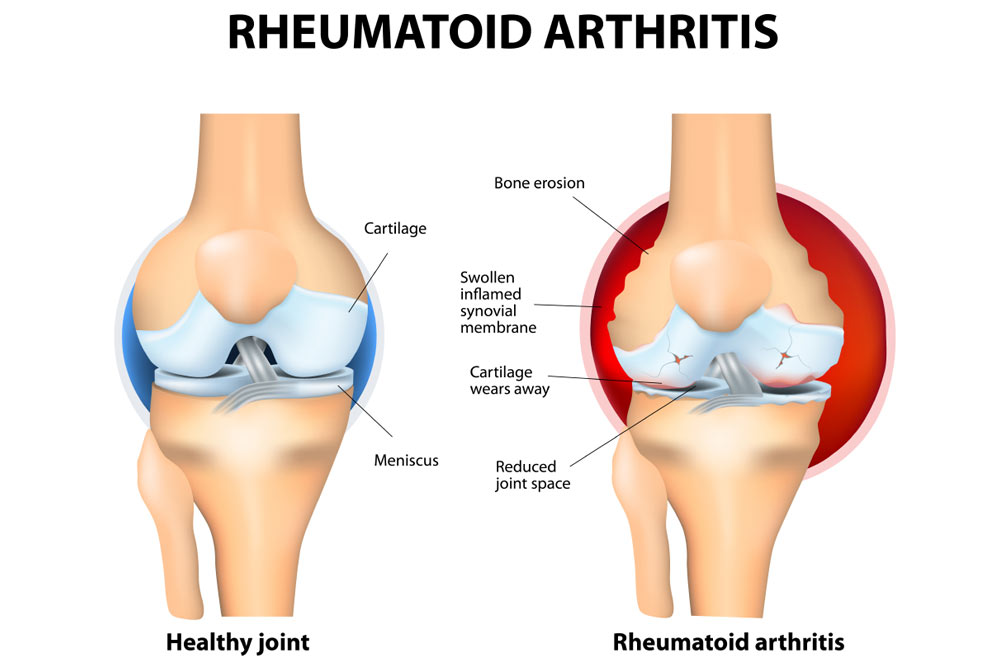 What is Rheumatoid Arthritis?‍